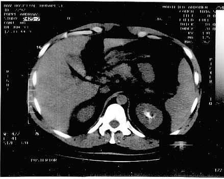 A computer tomography image from 1993